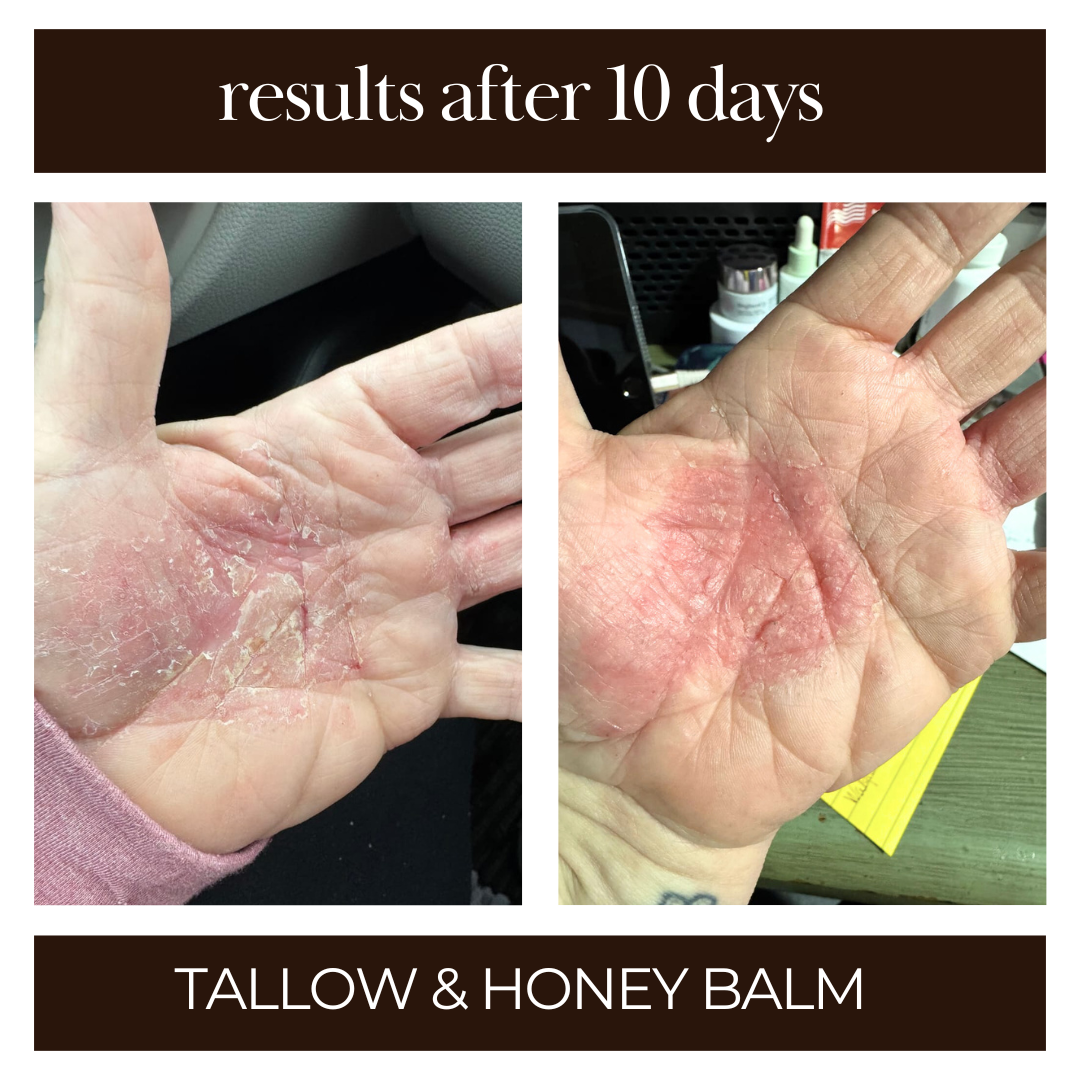 Before and after comparison of a hand treated with tallow and honey balm after 10 days.
